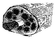 Peripheral Nerve Injury